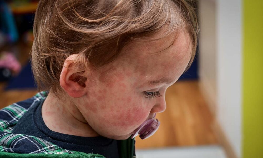 What To Know During a Measles Outbreak: FAQ