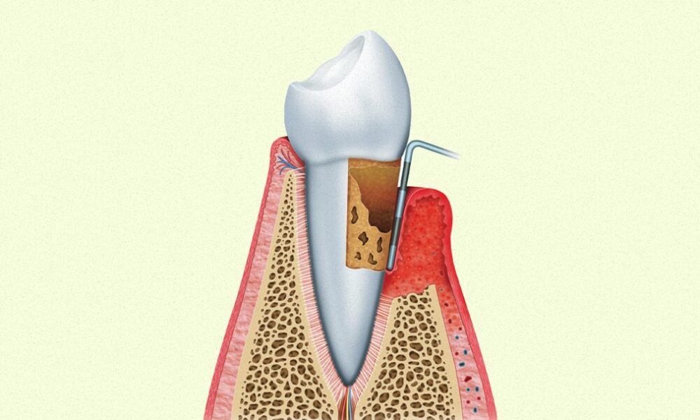 Gum Disease Might Be A Precursor To Diabetes