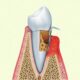 Gum Disease Might Be A Precursor To Diabetes