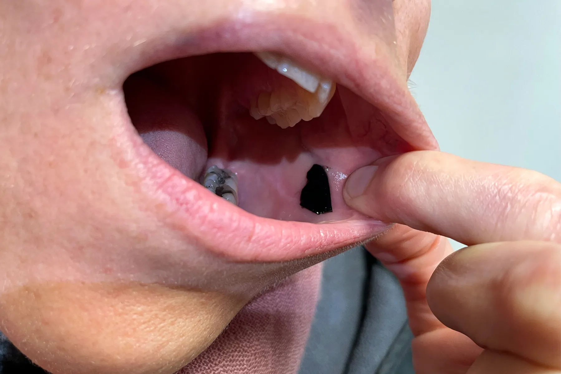 A buccal patch stuck to the inside of the mouth might deliver drugs more quickly and with fewer side effects.