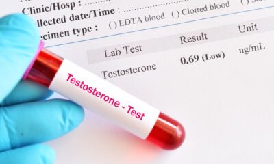 Abnormal low testosterone hormone test result