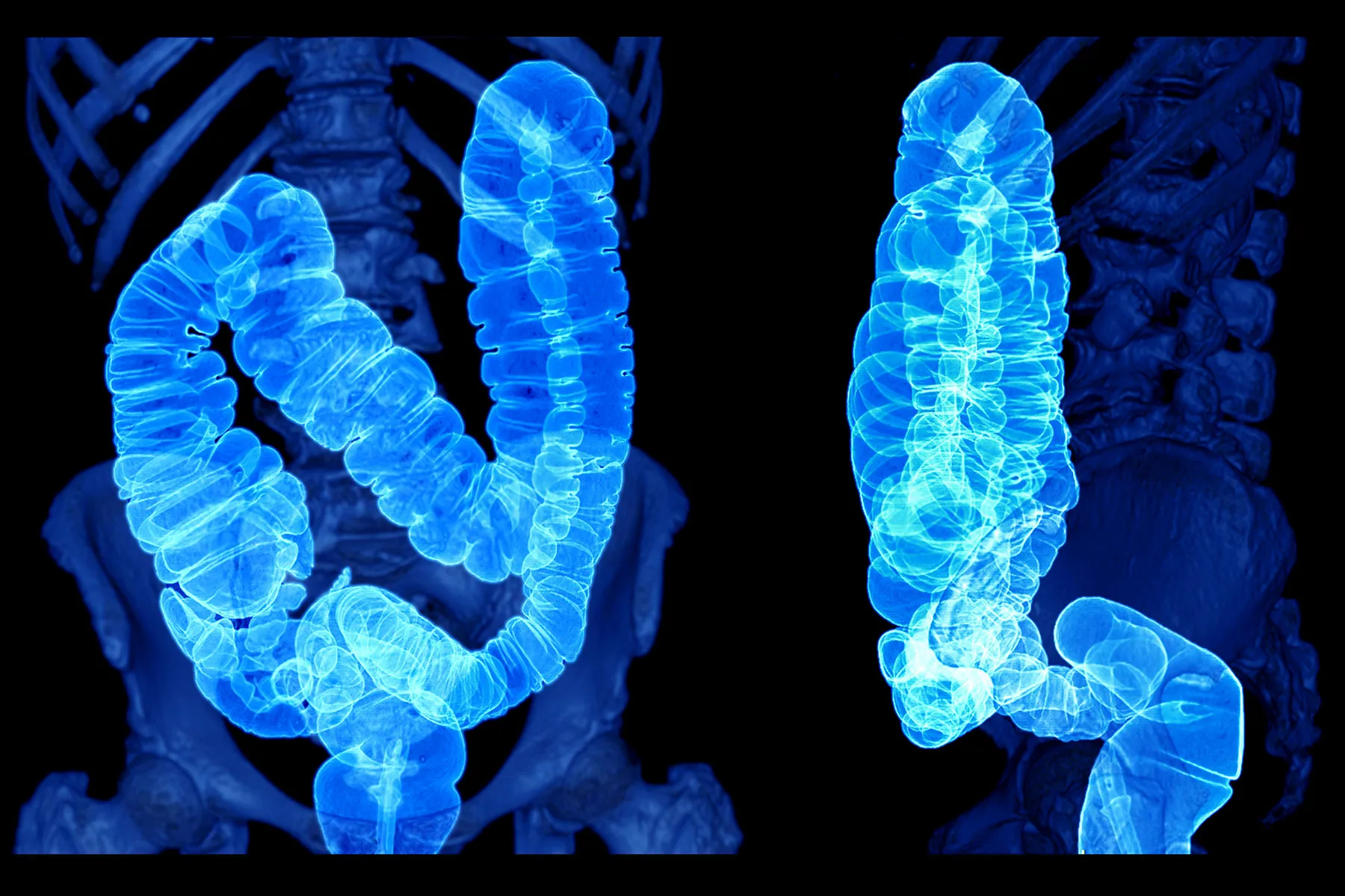 Behind the Spike in Colorectal Cancer Among Young Americans
