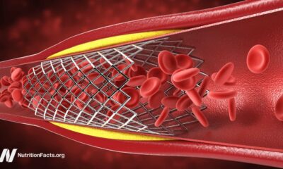 graphic of a cross-section of an artery with a stent in it