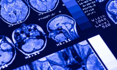 Study: ω-3 PUFA for Secondary Prevention of White Matter Lesions and Neuronal Integrity Breakdown in Older Adults: A Randomized Clinical Trial. Image Credit: Bk87 / Shutterstock.com