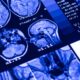 Study: ω-3 PUFA for Secondary Prevention of White Matter Lesions and Neuronal Integrity Breakdown in Older Adults: A Randomized Clinical Trial. Image Credit: Bk87 / Shutterstock.com