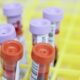 Blood Test Can Warn Women of Risk Decades Before Heart Attack, Stroke