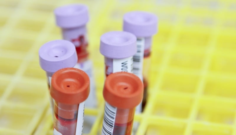 Blood Test Can Warn Women of Risk Decades Before Heart Attack, Stroke